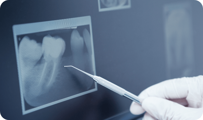 レントゲンの画像